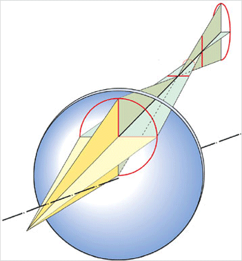 Astigmst schiefer bndel